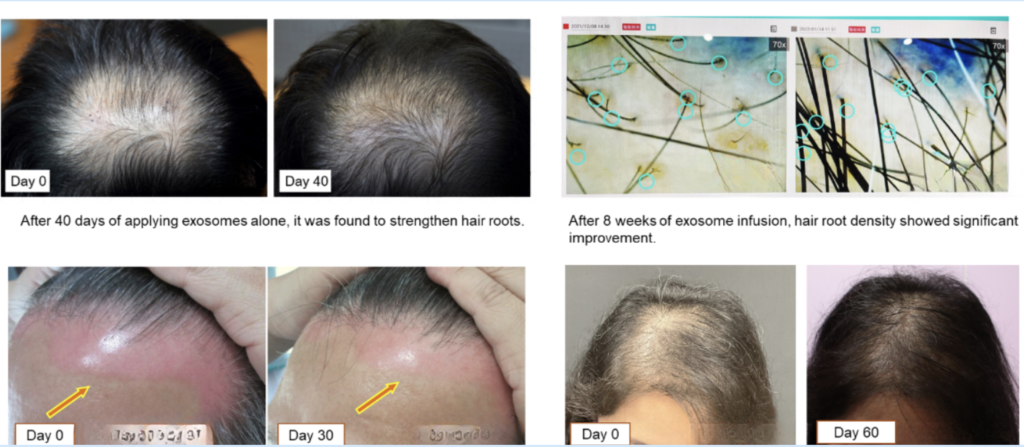 ExoHair Scalp Hydration Essence ExoPlus BIo Hair Loss Treatment