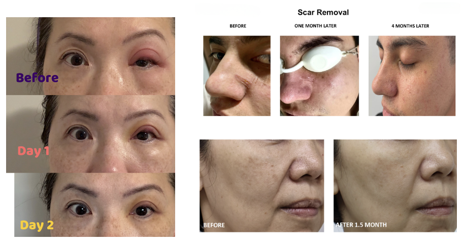 ExoCake Skin Hydration Essence Skin Before & After treatment