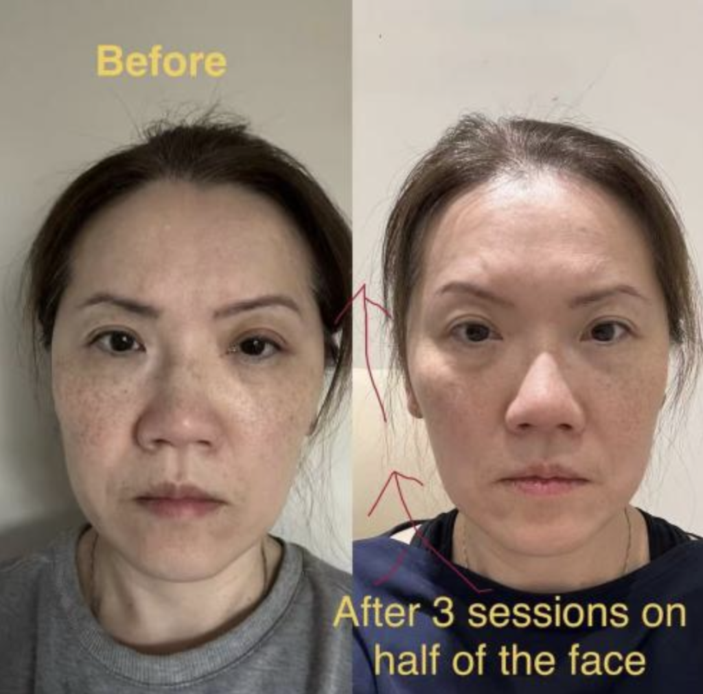 Before and After Vantis Hydrating Facial Mist